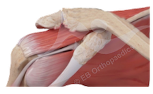 Acromioclavicular joint (ACJ) arthritis